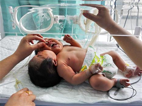 India: è nata una bambina con due teste