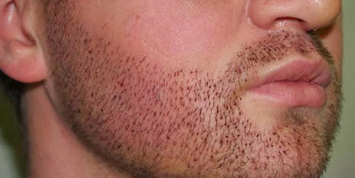 Il trapianto di barba: la nuova moda dell’uomo macho?