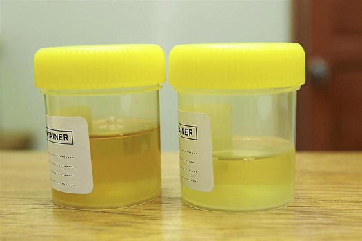 L’urina non è sterile. Questo il monito dei medici