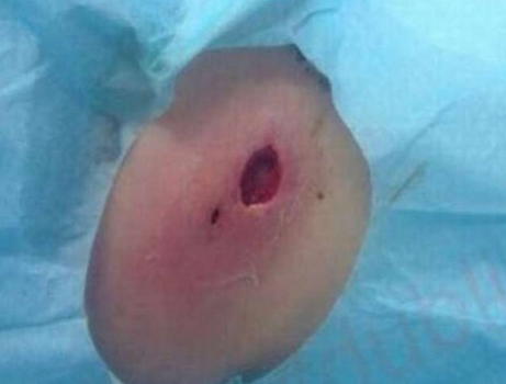 Un batterio divora la carne dei bagnanti. Ferito un ragazzo