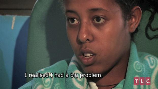Ragazza etiope convive per 17 anni con gemello parassita