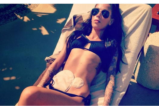 Ha il morbo di Crohn ma sogna di fare la modella. La sua foto con il sacchetto spopola in rete