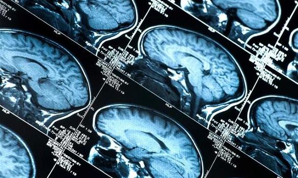 Alzheimer: una ricerca in Italia ne svela il meccanismo scatenante