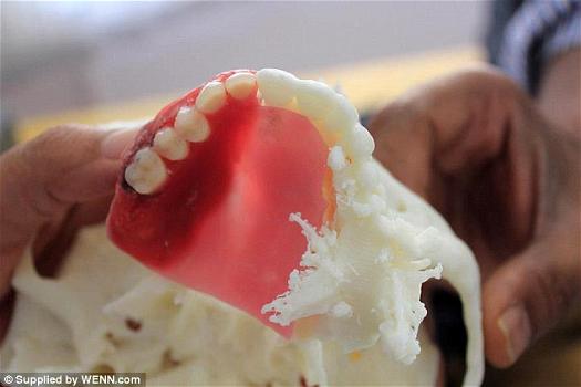 Malato di cancro ottiene nuovi denti grazie alla stampa 3D