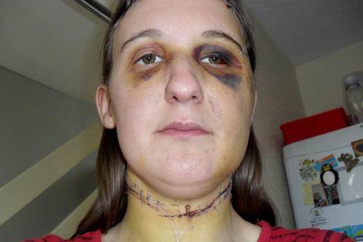 UK: donna sfregiata rischia il carcere se non scriverà al suo aguzzino
