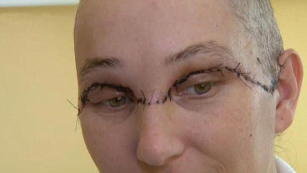 Terribile incidente: si strappa il cuoio capelluto con il trapano