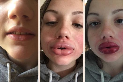 Kylie Jenner Lip Challenge, la nuova moda che impazza tra gli adolescenti