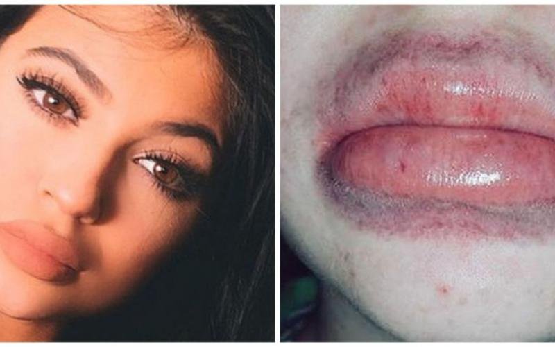 Kylie Jenner Lip Challenge, la nuova moda che impazza tra gli adolescenti