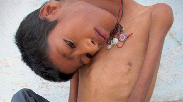 Mahendra Ahirwar: ecco il video del ragazzo nato senza i muscoli del collo