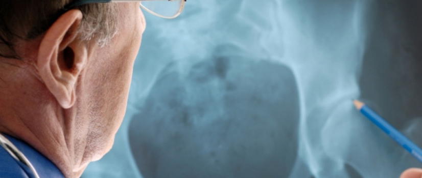 Scoperta la proteina che lega il diabete all’osteoporosi