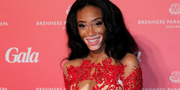 Una storia di coraggio…Winnie Harlow e “la bellezza della diversità”!