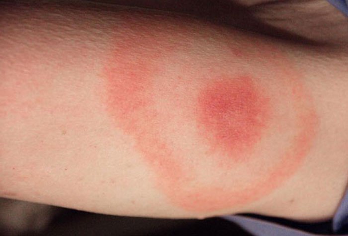 Malattia di Lyme: cause, sintomi e cure