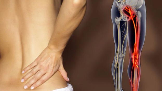 Rimedi naturali e posture da adottare per la sciatica