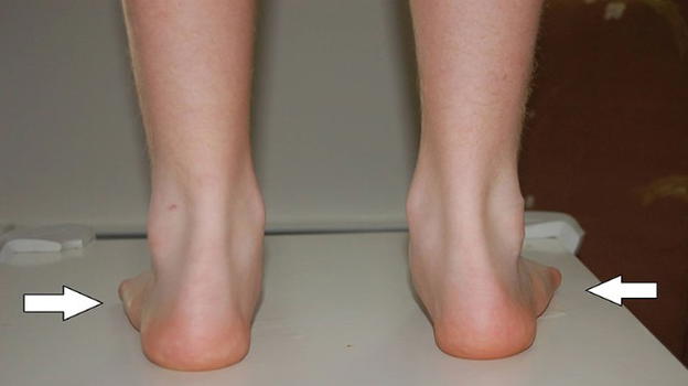 Piedi piatti, diagnosi corretta e rimedi per liberarsene