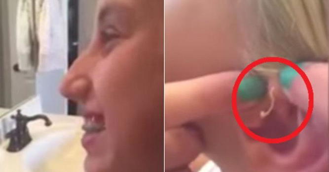 Ragazza schiaccia un brufolo vecchio 6 anni. Ecco cosa succede