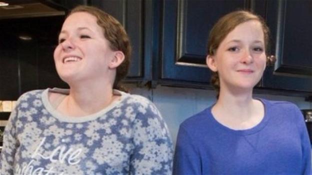 Charity e Kathleen Lincoln, gemelle siamesi separate a 6 mesi, 16 anni dopo
