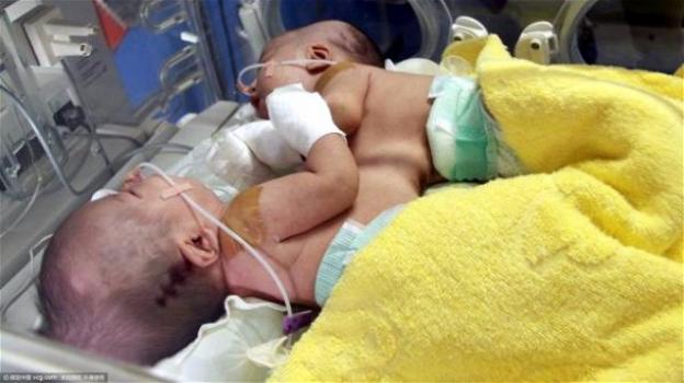 Cina: gemelli siamesi separati con successo, l’operazione è durata 4 ore