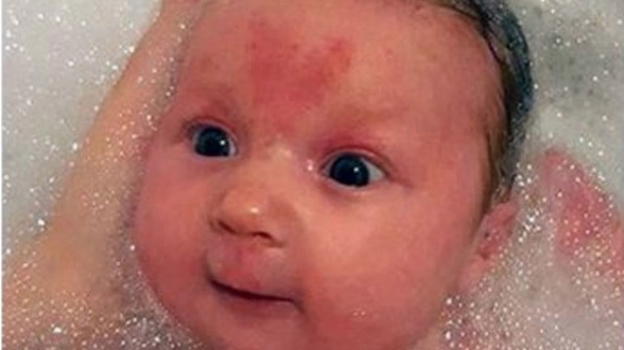 Fa impazzire il web il bambino con l’angioma a forma di cuore