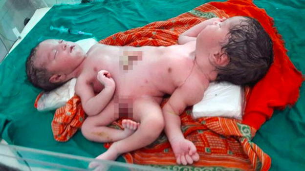 India, straordinario parto di gemelli siamesi di sesso diverso