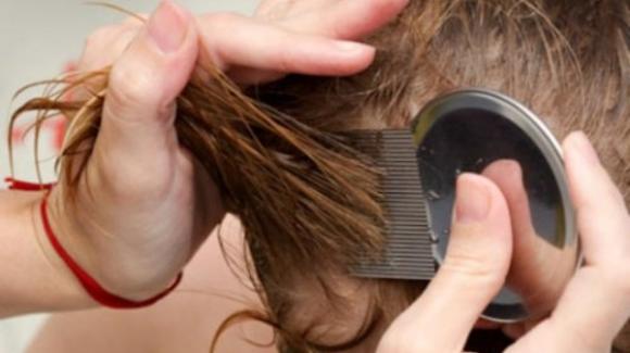 Allarme Super Pidocchi Negli Stati Uniti