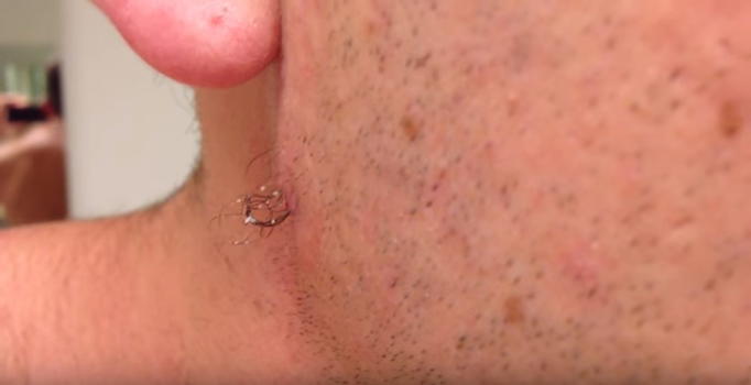Decide di togliere un pelo incarnito dal viso. Ecco cosa succede dopo