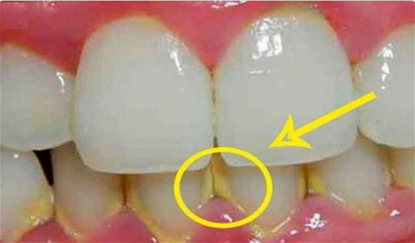 Come rimuovere la placca dai denti in 5 minuti ed in modo naturale. Non andrete più dal dentista