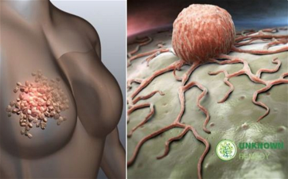 Questi sono alcuni sintomi del tumore al seno che le donne devono smettere di ignorare