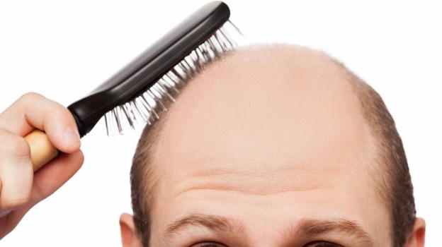 La calvizie causata da 287 geni ereditati dalle Mamme