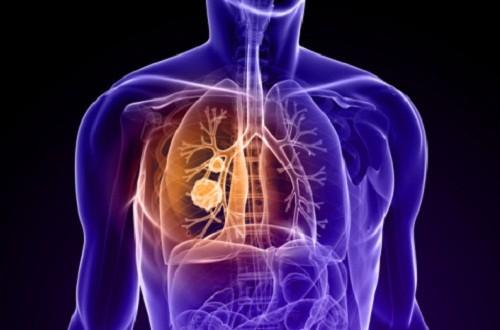 Tumore al polmone, non sottovalutate questi sintomi: potrebbero salvarvi la vita