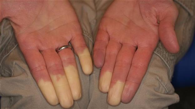 Sclerodermia: pallore delle dita indice di malattia anche fatale