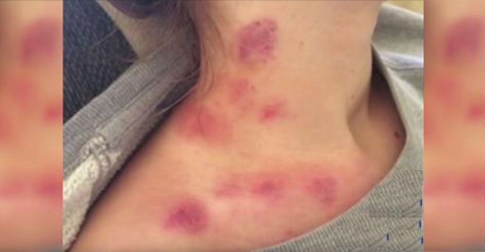 Dopo Quanto Si Muore Per Un Succhiotto