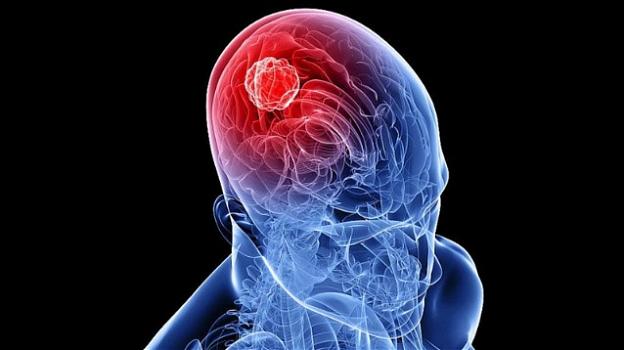 Acido oleico per diminuire il rischio di sviluppare tumori al cervello