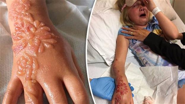 Tatuaggio all’henné provoca ustioni chimiche e cicatrici in una bambina di 7 anni