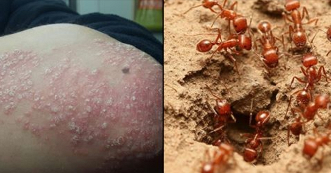 Psoriasi, il veleno delle formiche rosse come possibile cura. Ecco i risultati di una ricerca