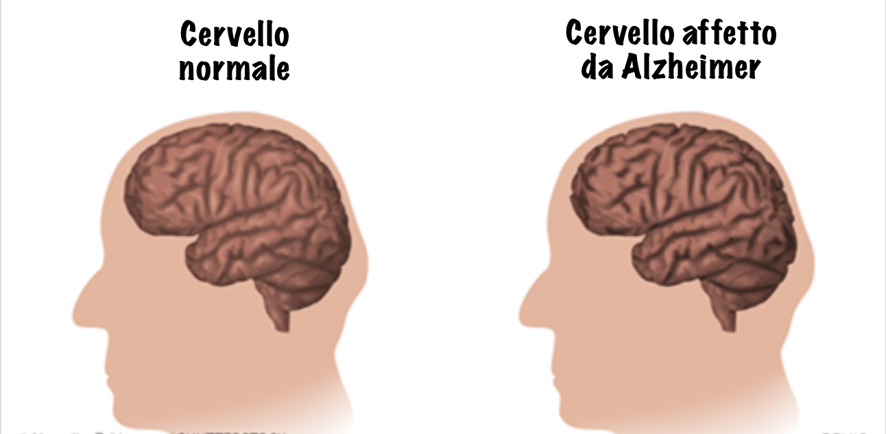 Alzheimer E Demenza Senile Sono La Stessa Cosa