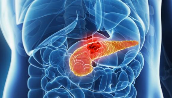 Tumore Al Pancreas Come Si Muore