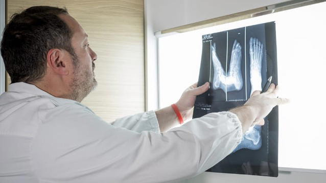 Ospedale di Genova: rivoluzione tecnica per la cura dell’alluce valgo