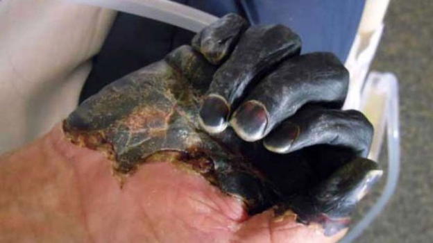Torna la peste bubbonica: il primo caso dopo 27 anni