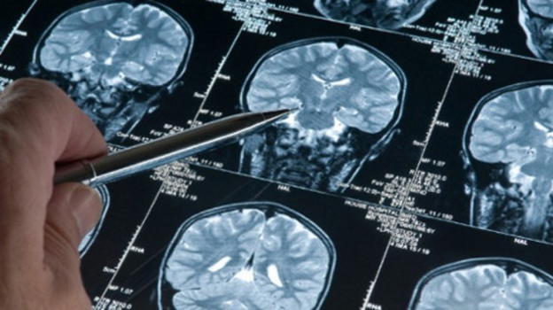 Crescita di metastasi nel cervello: all’Ospedale Molinette di Torino scoperto il meccanismo che la provoca