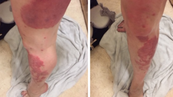 Una donna ‘guarisce’ dalla sua psoriasi cronica grazie a una crema idratante da 5€
