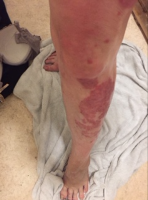 Una donna ‘guarisce’ dalla sua psoriasi cronica grazie a una crema idratante da 5€