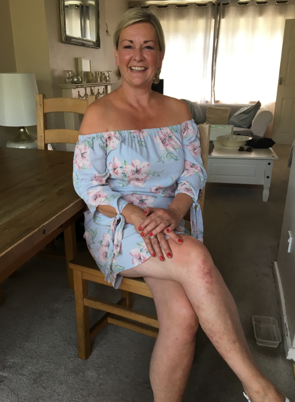 Una donna ‘guarisce’ dalla sua psoriasi cronica grazie a una crema idratante da 5€