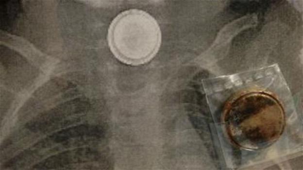 Bimbo di 4 anni ingoia una disk battery. Salvo grazie ai medici