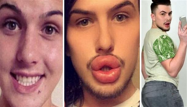 Si fa ingrandire labbra e sedere per somigliare alle Kardashian. Il folle gesto diventa virale!