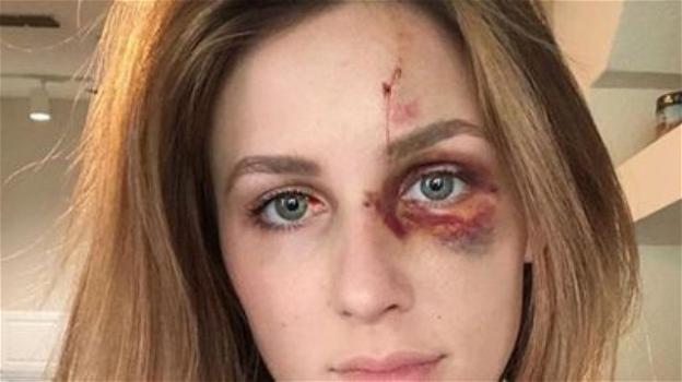 Florida, picchiata brutalmente dal fidanzato per una foto su Instagram
