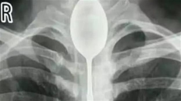 Ha forti dolori al petto: radiografia svela un cucchiaio ingoiato un anno prima