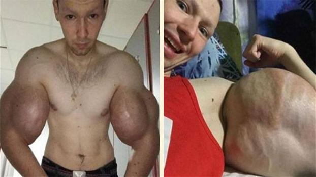 Bodybuilder si inietta olio nei bicipiti: “ho le braccia più grandi della Russia”