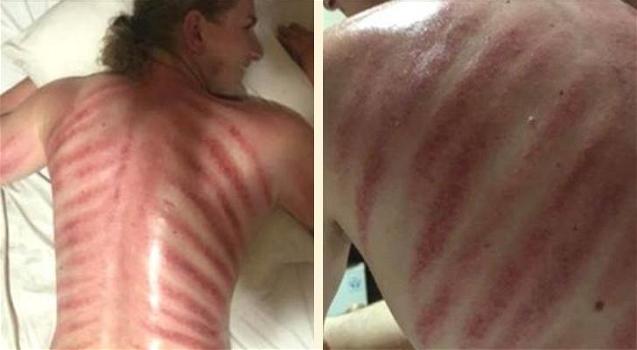 Turista si sottopone ad un massaggio “Red Dragon”: i segni lasciati sulle spalle sono scioccanti