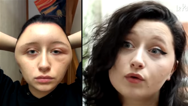 Ha una reazione allergica alla tintura per capelli: la testa di questa ragazza diventa impressionante!