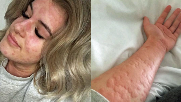 Il dramma di una 29enne: “Sono allergica all’inverno”. Costretta in ospedale anche per uno spiffero